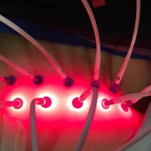 Laser Needle Gerät in Aktion